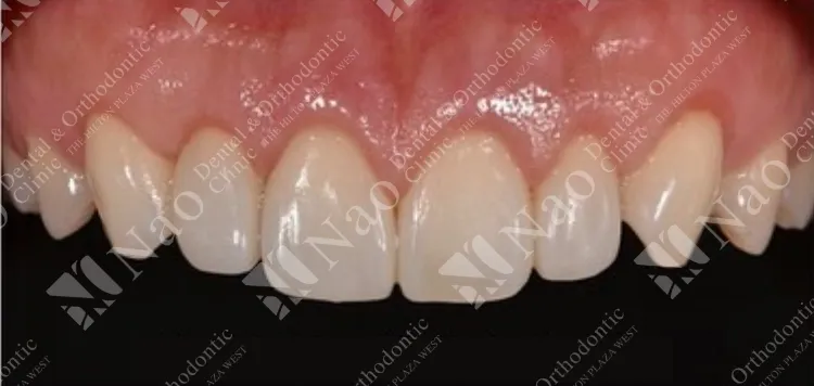 歯の美しさを短期間で修復ダイレクトボンディング