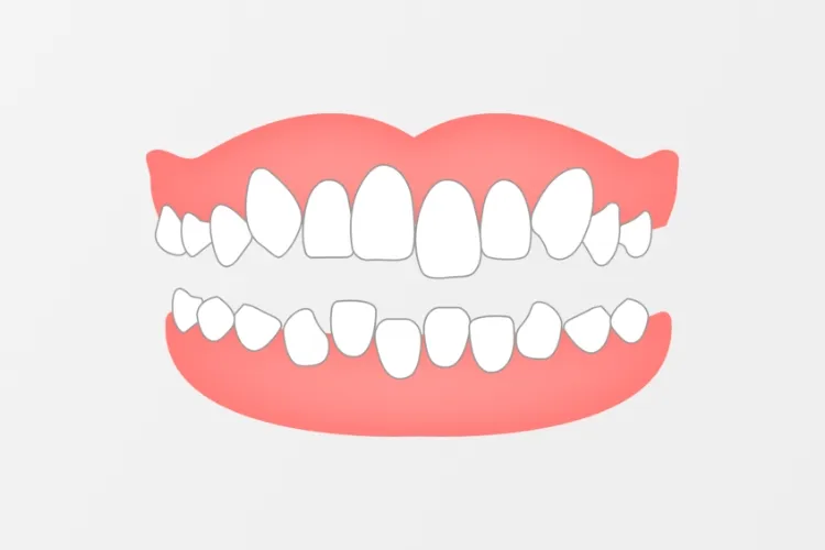 ガタガタ歯並びを矯正するメリット