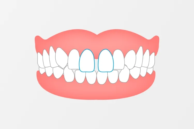 すきっ歯を矯正するメリット